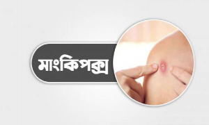 মাঙ্কিপক্স সন্দেহে দেশে একজন হাসপাতালে ভর্তি